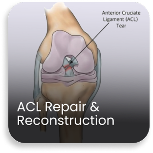 Medical illustration showing ACL tear and reconstruction procedure performed in the orthopedic department of a bone and joint hospital