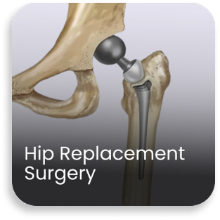 Illustration of hip replacement surgery showing artificial hip joint used in advanced orthopedic care at a bone and joint hospital