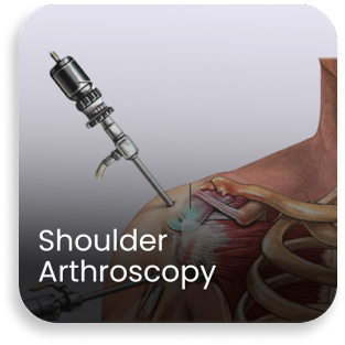 Medical illustration showing shoulder arthroscopy using minimally invasive technique in the orthopedic department of a bone and joint hospital