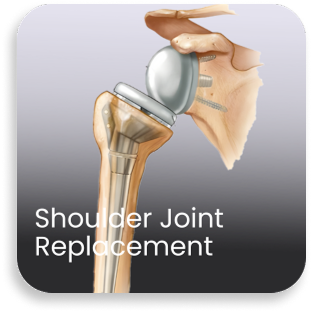 Illustration of shoulder joint replacement showing artificial shoulder implant used in advanced orthopedic surgery at a bone and joint hospital