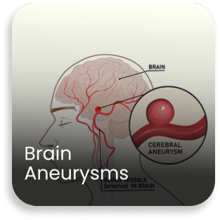 Medical diagram showing a brain aneurysm in cerebral blood vessels highlighting care at a best brain surgery hospital in India