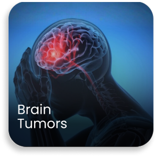 Illustration showing a brain tumor highlighting the need for advanced care at a best neurosurgery hospital in India