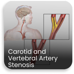 Medical illustration showing carotid and vertebral artery narrowing affecting brain blood flow treated at a best neurology hospital in India