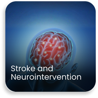Illustration showing brain stroke treated through advanced neurointervention at a best neurology hospital in India