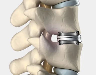 Illustration of artificial disc replacement, where a damaged spinal disc is replaced with an artificial one to mimic natural movement and preserve spine flexibility, offering a modern alternative to spinal fusion.