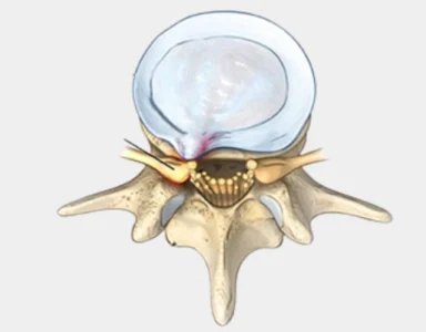 Illustration of a laminectomy procedure, where a portion of the vertebra is removed to relieve pressure on the spinal cord and nerves, commonly used to treat spinal stenosis.