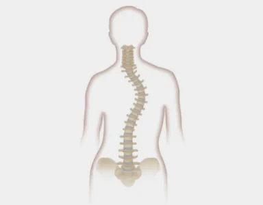 Illustration showing scoliosis surgery, where metal rods and screws are used to straighten and stabilize the spine, often recommended for severe spinal curvature with a longer recovery time.