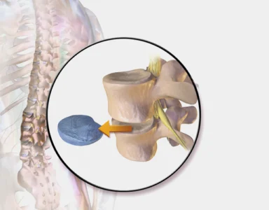 Illustration showing a herniated disc in the spine and the process of removing the damaged disc (discectomy) to relieve pressure on nerves, helping reduce pain and discomfort.