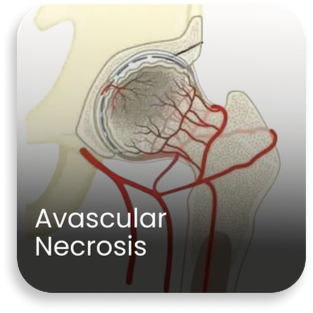 Medical illustration showing avascular necrosis with reduced blood supply causing bone damage in the knee joint, treated by the best knee replacement surgeons in Haryana providing advanced knee replacement surgery in Haryana at Aditya Hospital.