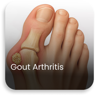 Medical illustration of gout arthritis showing uric acid crystal deposits in the joint, representing advanced diagnosis and knee replacement surgery in Haryana by the best knee replacement surgeons in Haryana at Aditya Hospital.