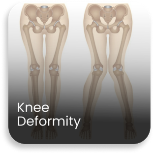Medical illustration showing knee deformity with misaligned leg bones, highlighting advanced knee replacement surgery in Haryana performed by the best knee replacement surgeon in Haryana at Aditya Hospital.