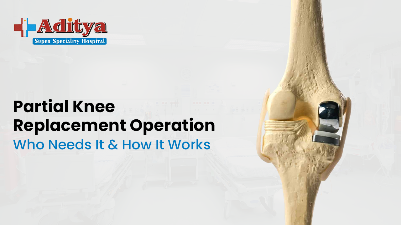 3D knee model showing partial knee replacement procedure with implant placed in damaged compartment, illustrating how partial knee replacement surgery works for chronic knee pain patients