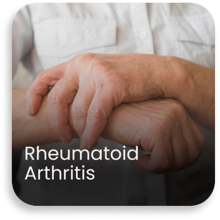 Swollen and inflamed joints due to rheumatoid arthritis, representing advanced diagnosis and knee replacement surgery in Haryana by the best knee replacement surgeons in Haryana at Aditya Hospital.