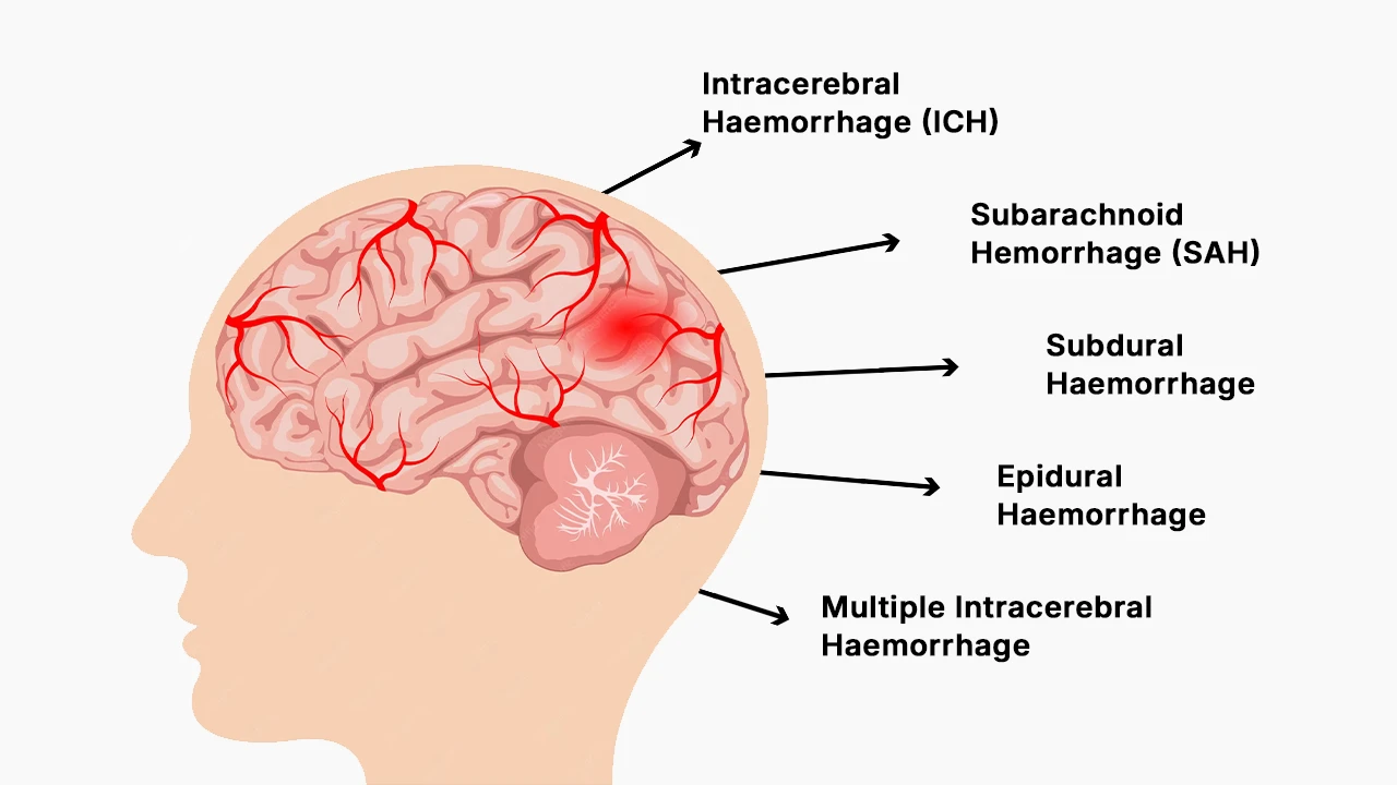 Diagram showing types of haemorrhage in the brain including intracerebral haemorrhage (ICH), subarachnoid haemorrhage, subdural haemorrhage, epidural haemorrhage and multiple intracerebral haemorrhage caused by blood leak in brain or high blood pressure.